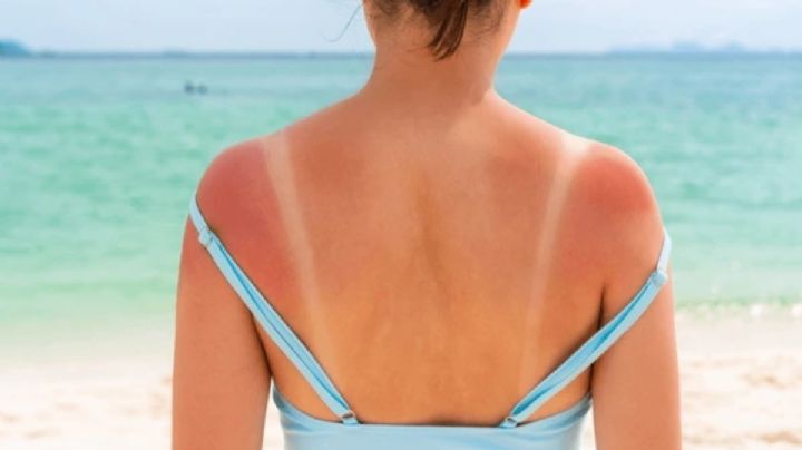 Cómo proteger tu piel del sol este verano: recomendaciones esenciales para cuidarte en Yucatán