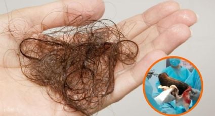 ¿Qué es y cómo detectar el Síndrome de Rapunzel? Operan a niña en Mérida